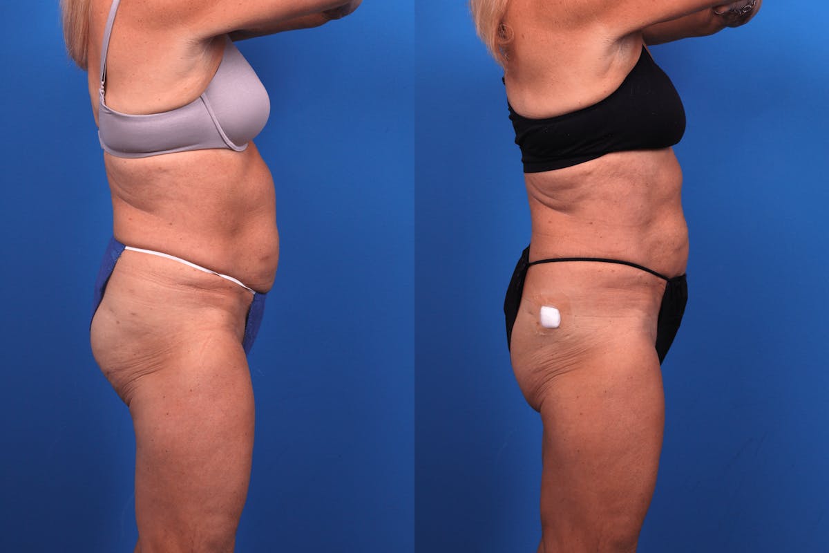 CoolSculpting Before & After Gallery - Patient 122405649 - Image 5