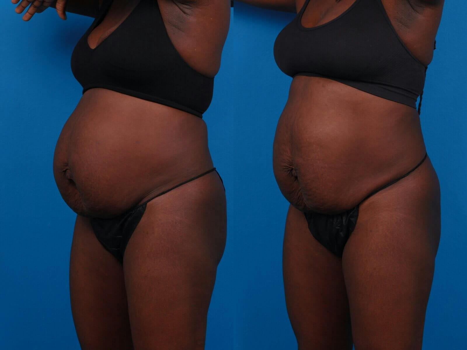 CoolSculpting Before & After Gallery - Patient 122405650 - Image 1