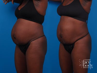 CoolSculpting Before & After Gallery - Patient 369452 - Image 1