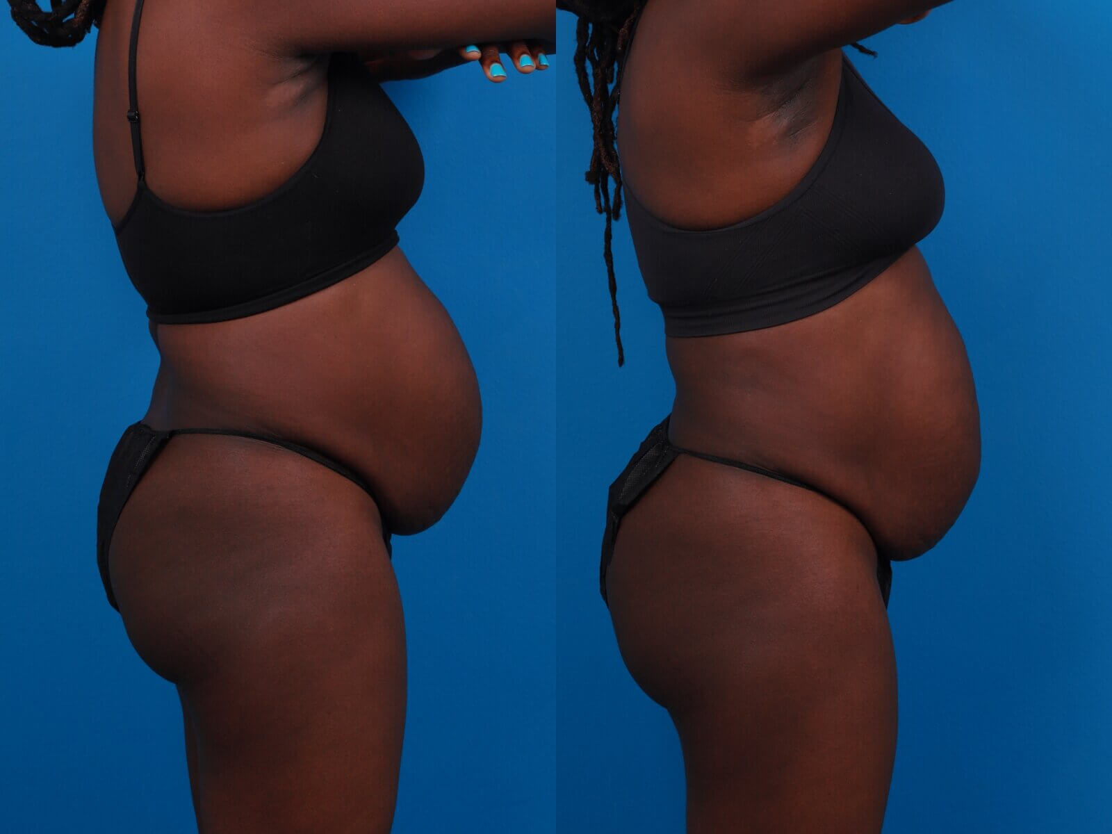 CoolSculpting Before & After Gallery - Patient 369452 - Image 2