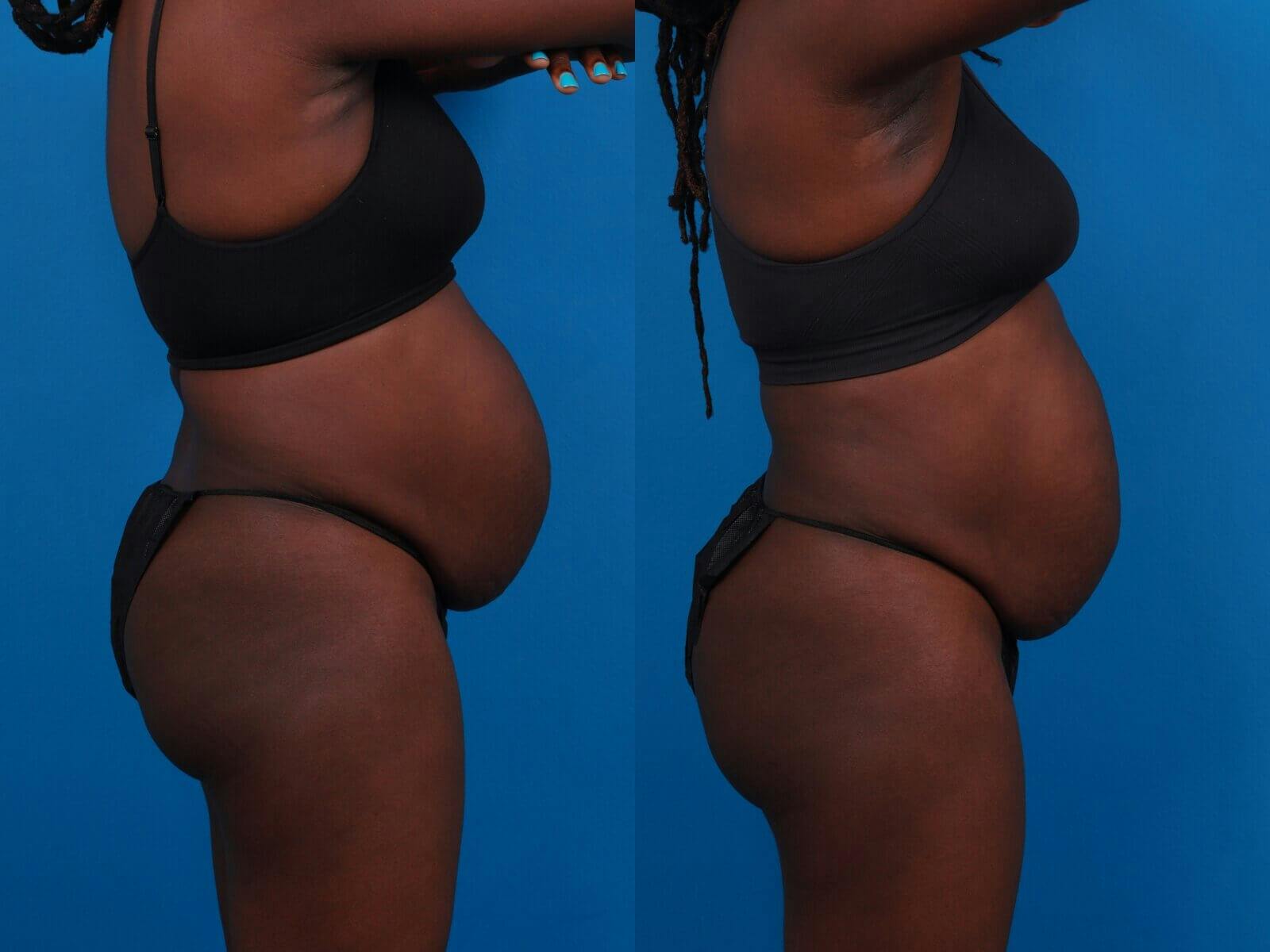 CoolSculpting Before & After Gallery - Patient 122405650 - Image 2