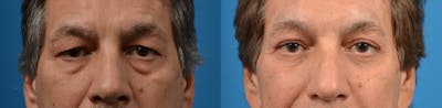 Eyelid Surgery Before & After Gallery - Patient 122405651 - Image 1