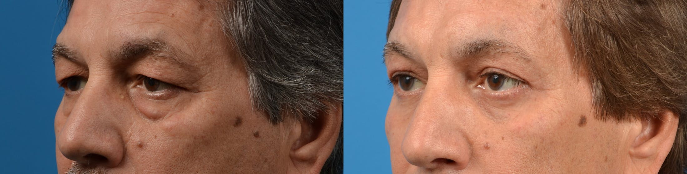 Eyelid Surgery Before & After Gallery - Patient 122405651 - Image 2
