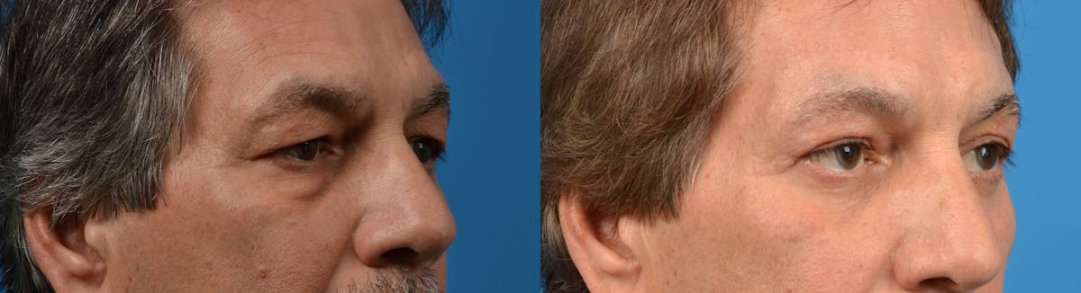 Eyelid Surgery Before & After Gallery - Patient 122405651 - Image 3