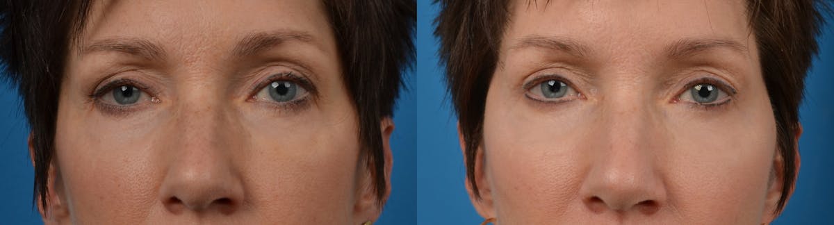 Eyelid Surgery Before & After Gallery - Patient 122405652 - Image 1