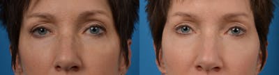 Eyelid Surgery Before & After Gallery - Patient 122405652 - Image 1