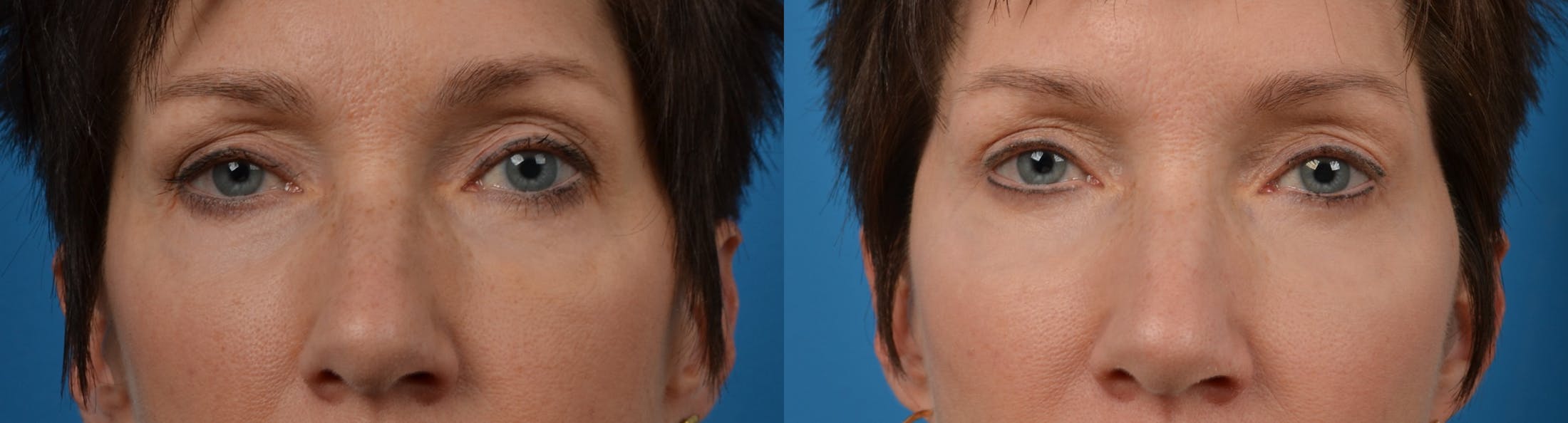 Eyelid Surgery Gallery - Patient 122405652 - Image 1