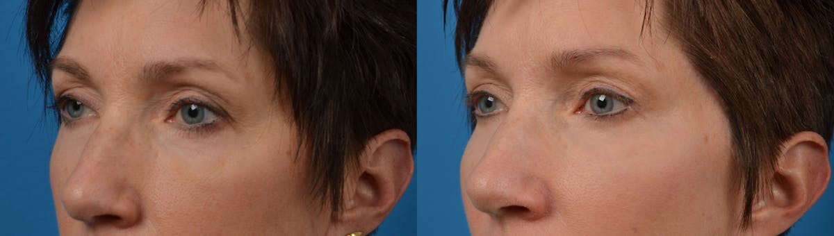 Eyelid Surgery Before & After Gallery - Patient 122405652 - Image 2