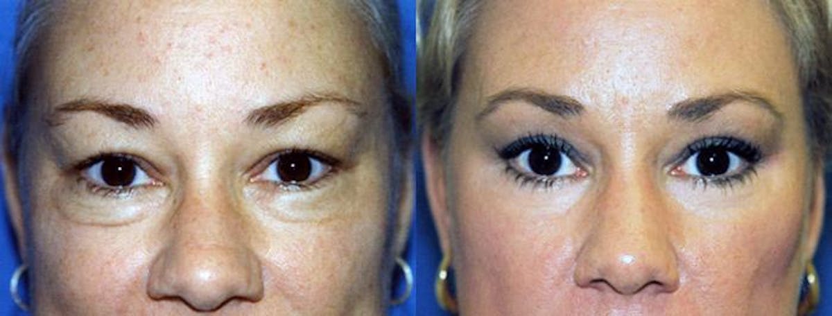Eyelid Surgery Before & After Gallery - Patient 122405653 - Image 1