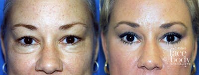 Eyelid Surgery Before & After Gallery - Patient 318735 - Image 1
