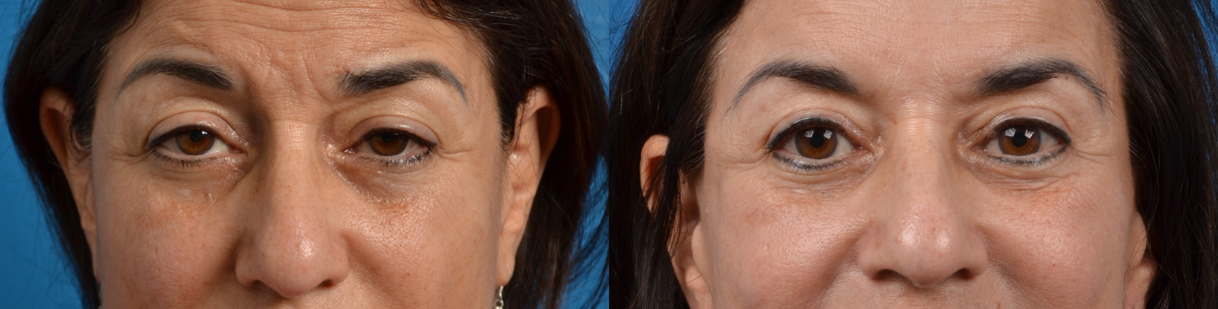 Eyelid Surgery Before & After Gallery - Patient 113738 - Image 1