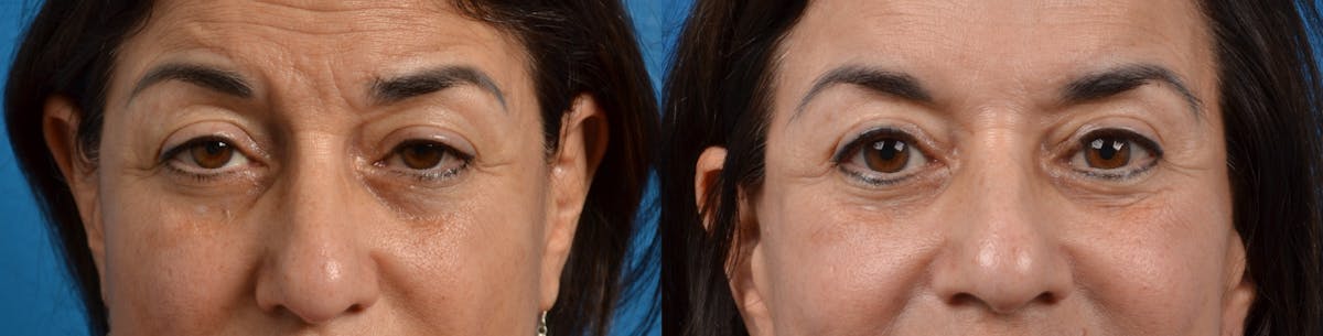 Eyelid Surgery Before & After Gallery - Patient 122405654 - Image 1