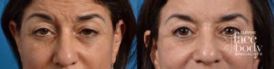 Eyelid Surgery Before & After Gallery - Patient 113738 - Image 1