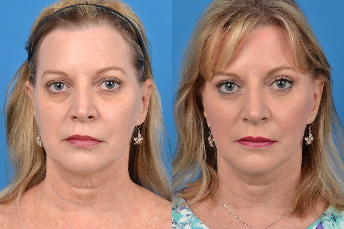 Facelift Before & After Gallery - Patient 122405656 - Image 1