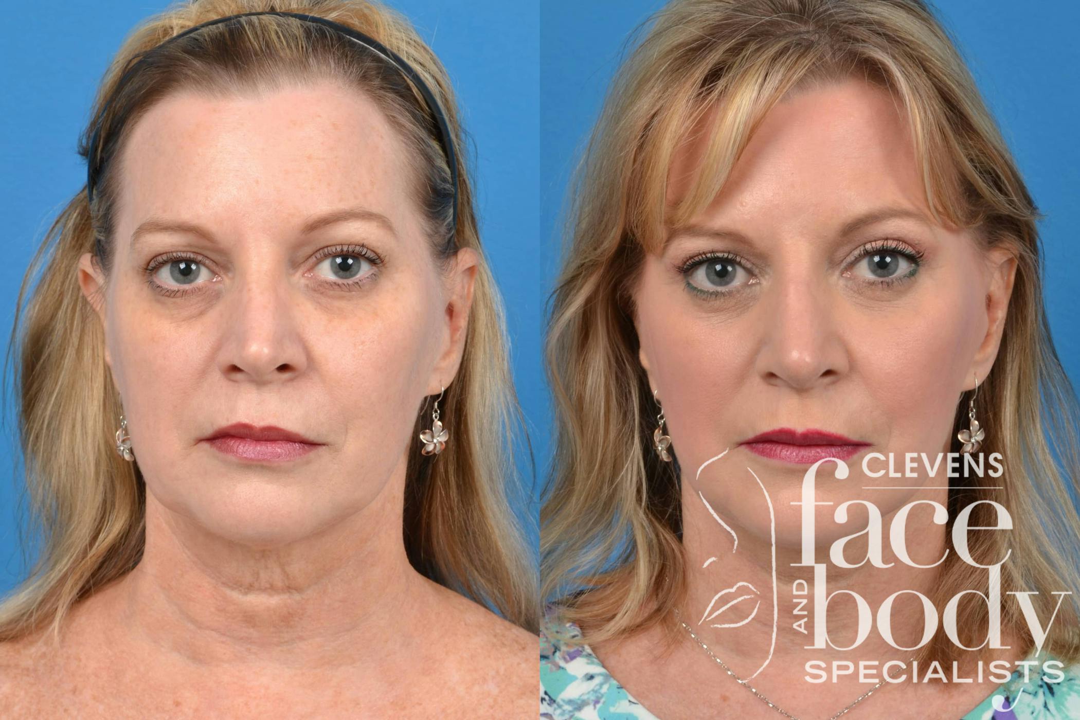 FaceLift Procedure results in FL with Clevens Face and Body Specialists