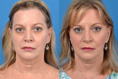 Facelift Before & After Gallery - Patient 122405656 - Image 1