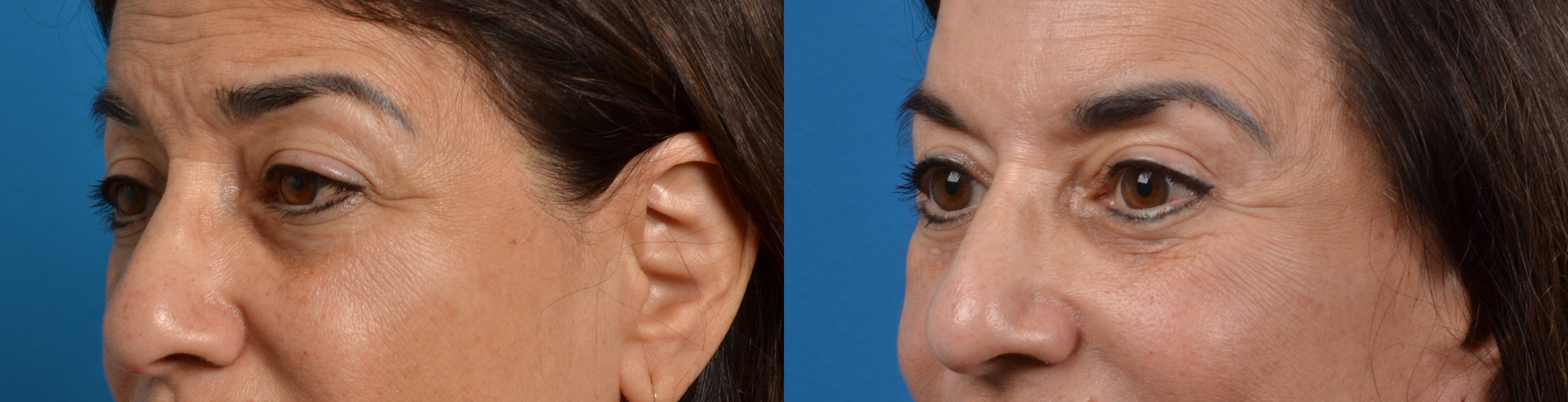 Eyelid Surgery Before & After Gallery - Patient 113738 - Image 2