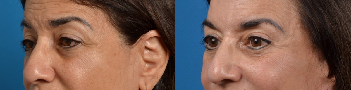 Eyelid Surgery Before & After Gallery - Patient 122405654 - Image 2