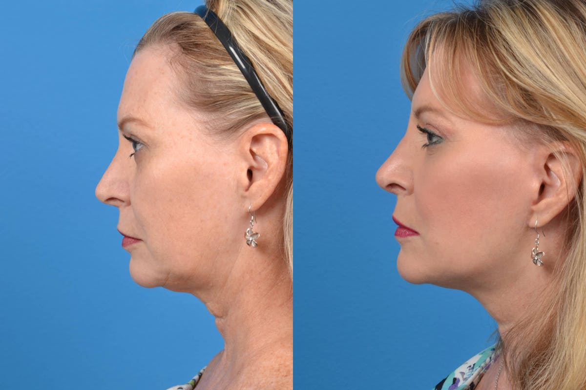 Facelift Before & After Gallery - Patient 122405656 - Image 2