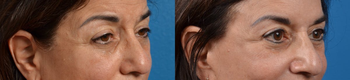 Eyelid Surgery Before & After Gallery - Patient 122405654 - Image 3