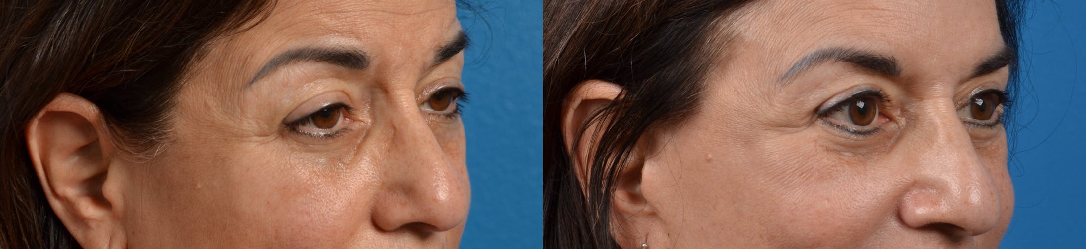 Eyelid Surgery Before & After Gallery - Patient 122405654 - Image 3