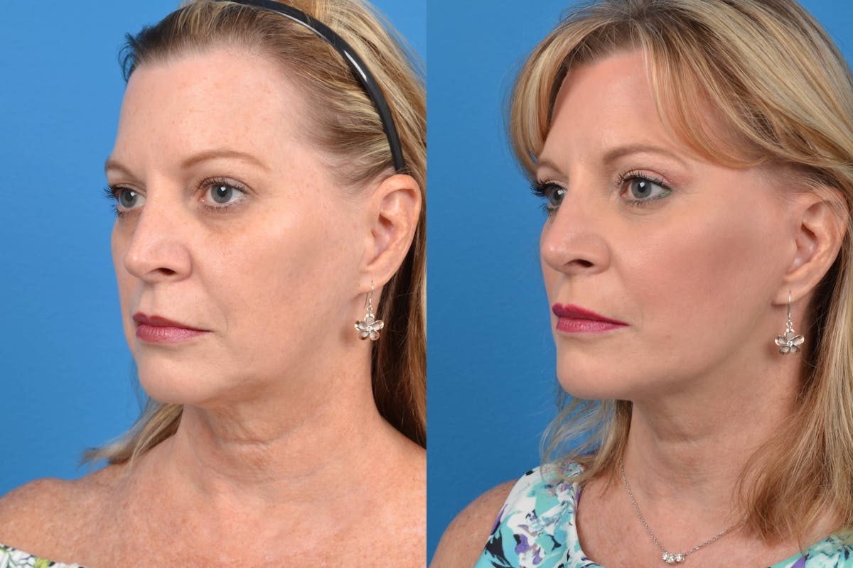 Facelift Before & After Gallery - Patient 122405656 - Image 3