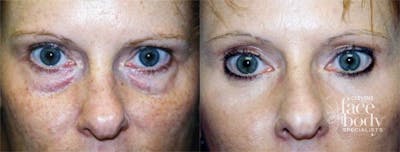 Eyelid Surgery Before & After Gallery - Patient 407725 - Image 1
