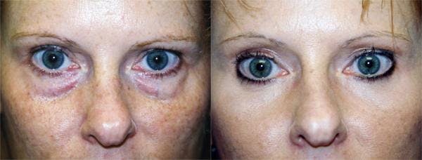 Eyelid Surgery Before & After Gallery - Patient 122405655 - Image 1