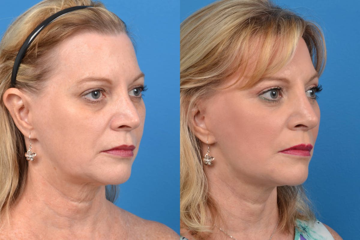 Facelift Before & After Gallery - Patient 122405656 - Image 4