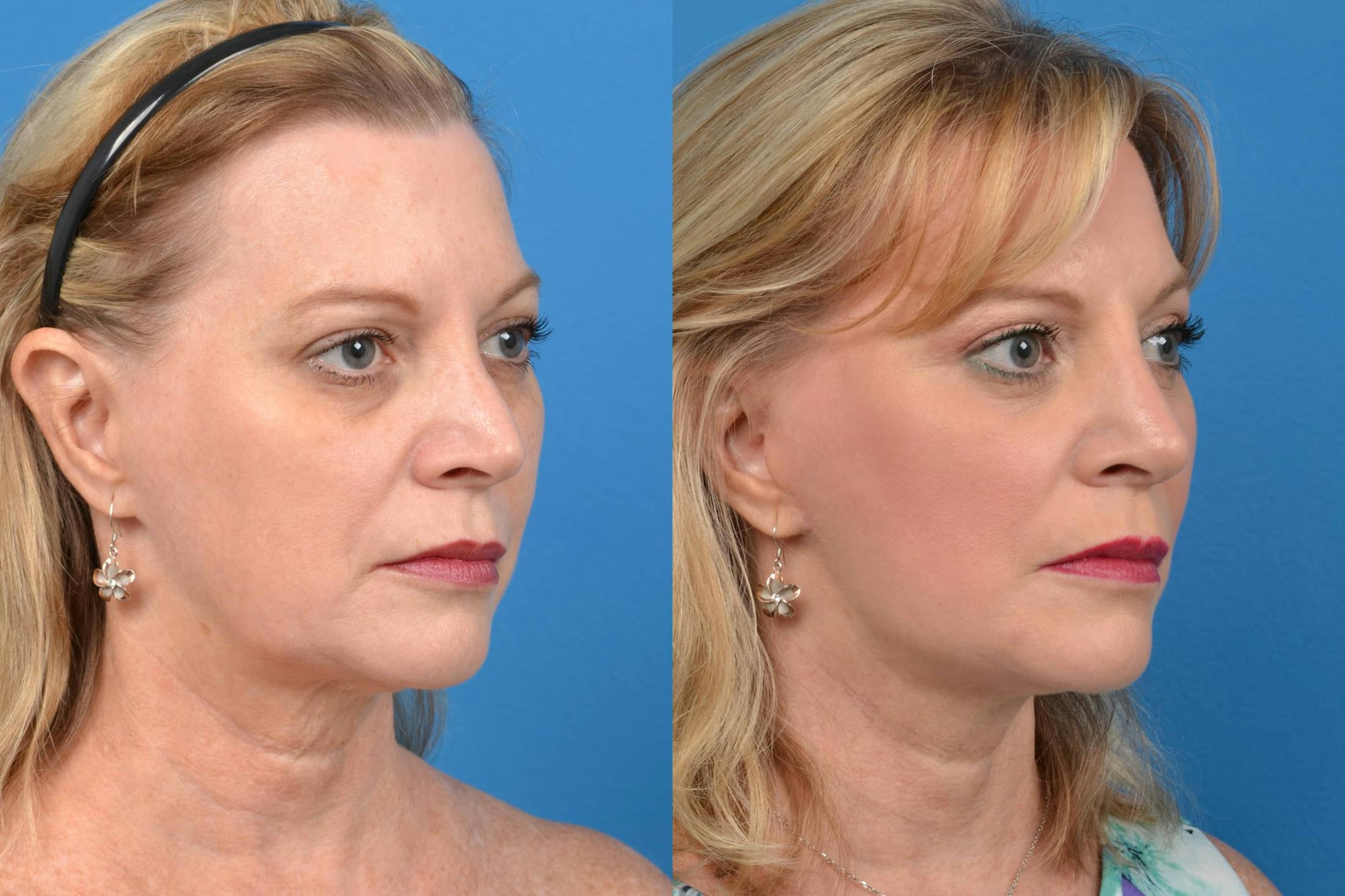 Facelift Before & After Gallery - Patient 122405656 - Image 4