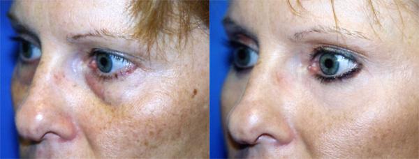 Eyelid Surgery Before & After Gallery - Patient 407725 - Image 2