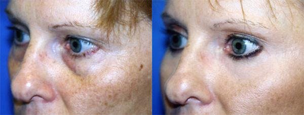 Eyelid Surgery Before & After Gallery - Patient 122405655 - Image 2