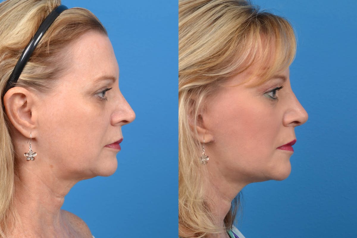 Facelift Before & After Gallery - Patient 122405656 - Image 5