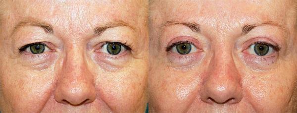 Eyelid Surgery Before & After Gallery - Patient 220550 - Image 1