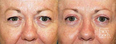 Eyelid Surgery Before & After Gallery - Patient 220550 - Image 1