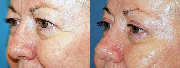 Eyelid Surgery Before & After Gallery - Patient 122405657 - Image 2
