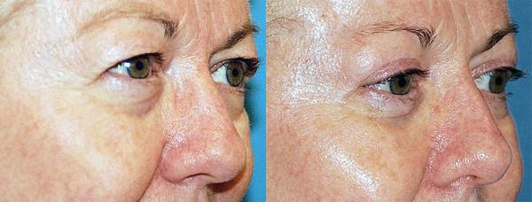 Eyelid Surgery Before & After Gallery - Patient 220550 - Image 3