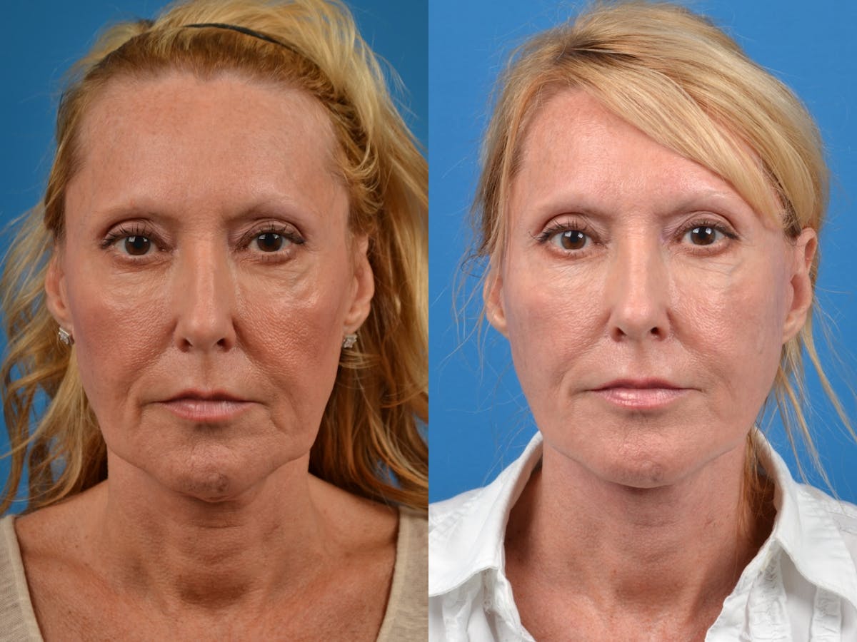 Facelift Before & After Gallery - Patient 122405660 - Image 1