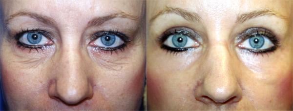 Eyelid Surgery Before & After Gallery - Patient 386349 - Image 1