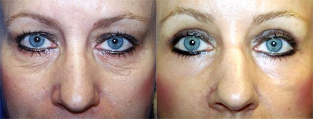 Eyelid Surgery Before & After Gallery - Patient 122405658 - Image 1