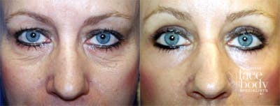 Eyelid Surgery Before & After Gallery - Patient 386349 - Image 1