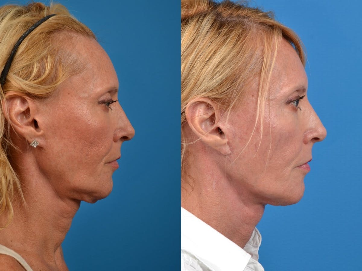 Facelift Before & After Gallery - Patient 122405660 - Image 2