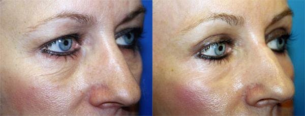 Eyelid Surgery Before & After Gallery - Patient 122405658 - Image 2