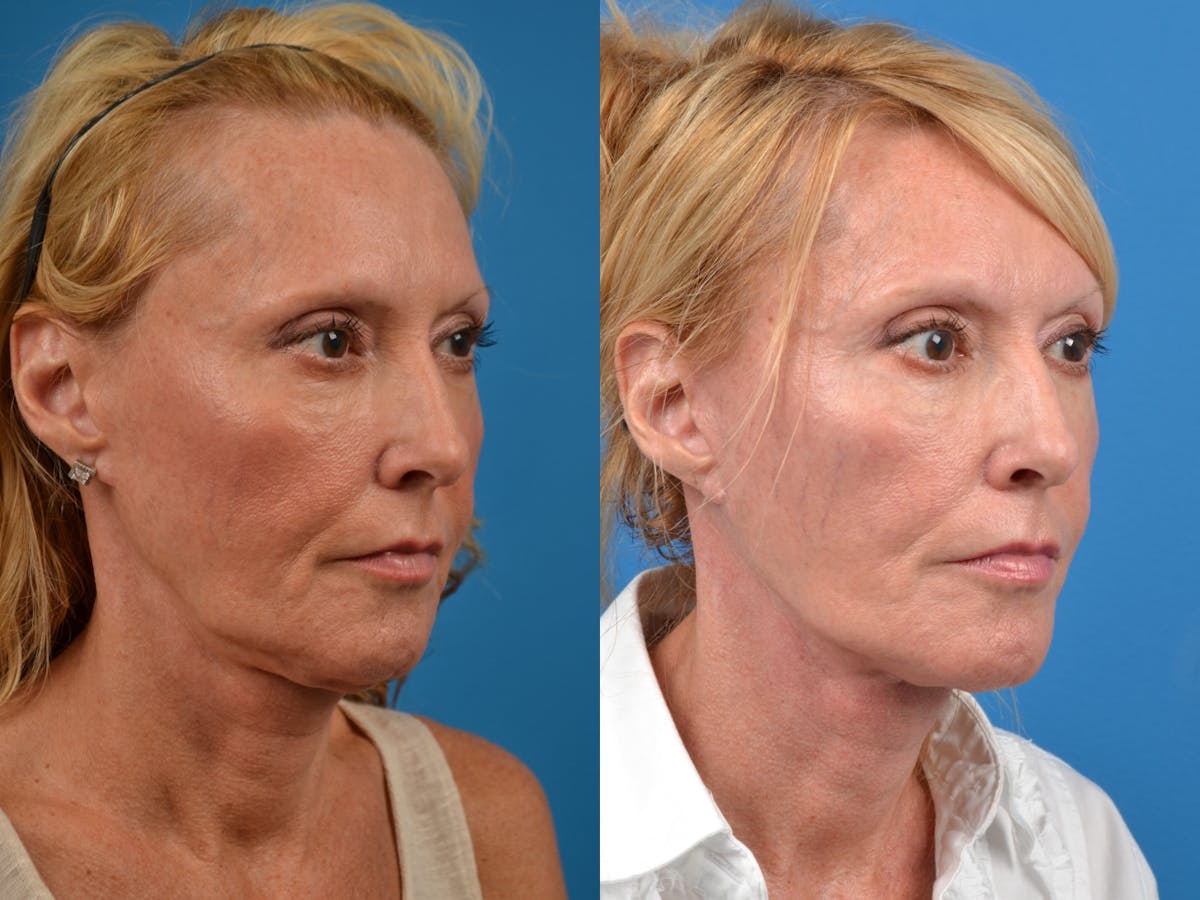 Facelift Before & After Gallery - Patient 122405660 - Image 3