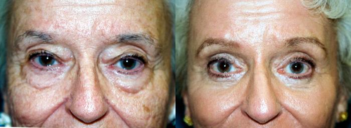 Eyelid Surgery Before & After Gallery - Patient 227493 - Image 1
