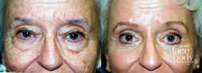 Eyelid Surgery Before & After Gallery - Patient 227493 - Image 1