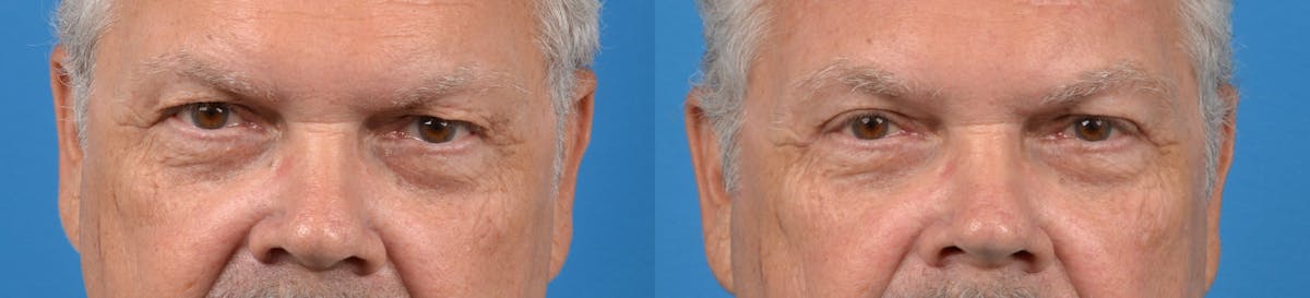 Eyelid Surgery Before & After Gallery - Patient 122405662 - Image 1