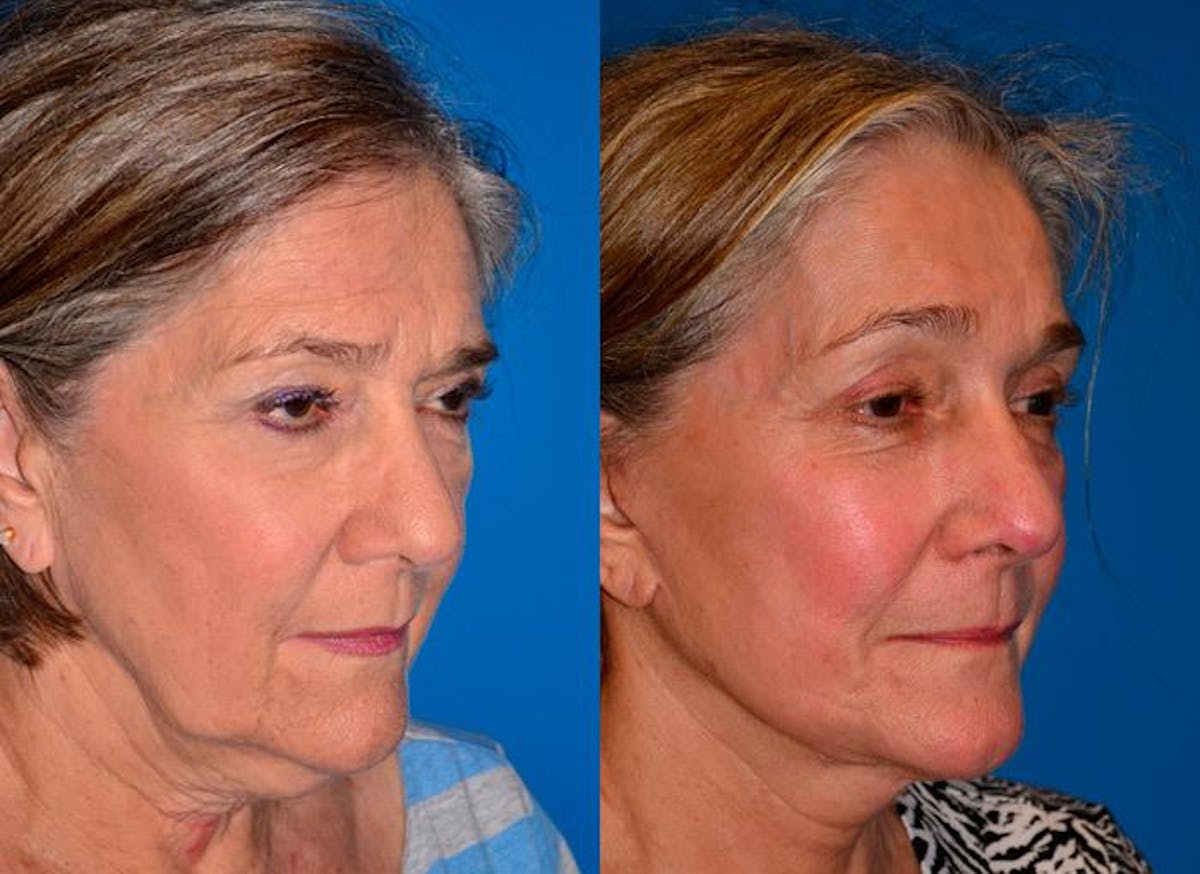 Facelift Before & After Gallery - Patient 122405663 - Image 1