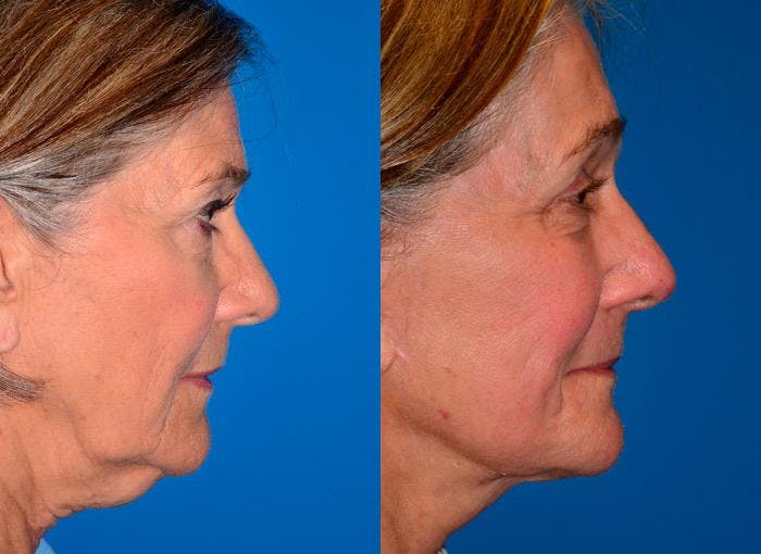 Facelift Before & After Gallery - Patient 122405663 - Image 2