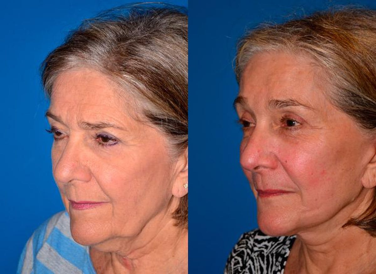 Facelift Before & After Gallery - Patient 122405663 - Image 3